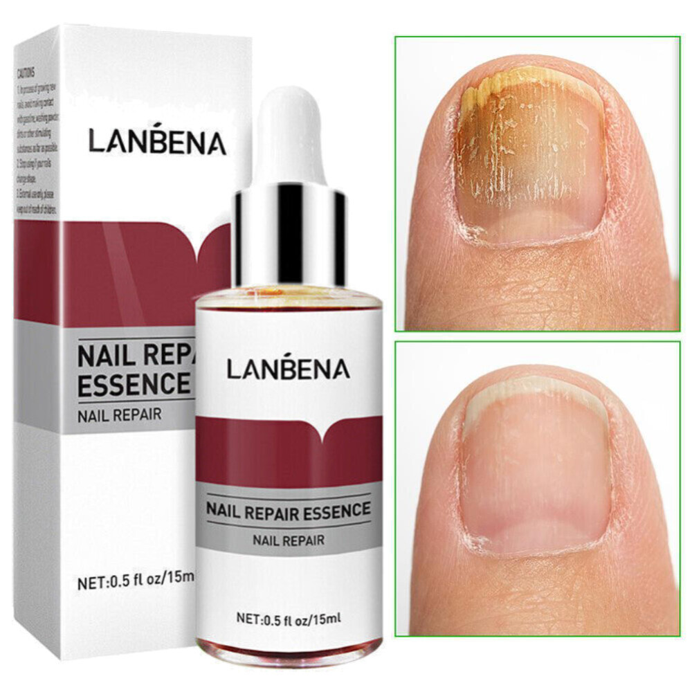 LANBENA Nail Repair Essence Oil for Fungal Treatment and Onychomycosis Relief