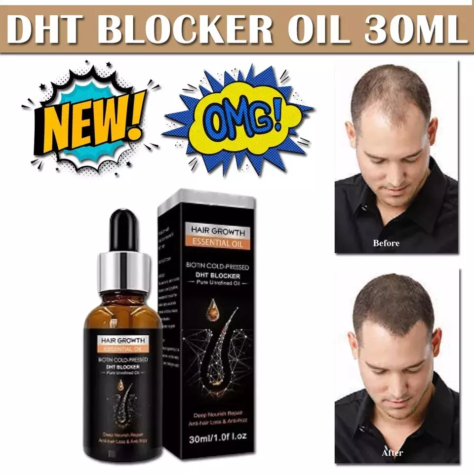 Patented Mega Growth Oil For Hair Fast Growing DHT Blocker Reduce Hair Loss
